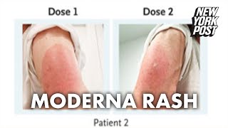 Side effect of Moderna vaccine may be a delayed skin rash doctors warn  New York Post [upl. by Kcirdorb822]